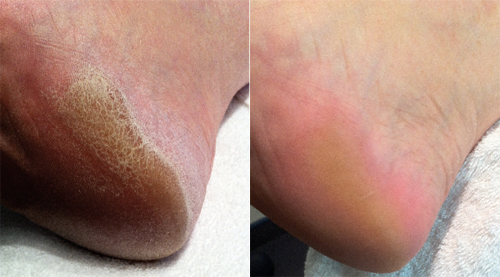 Calluspeeling traitement professionnel pour la beauté des pieds